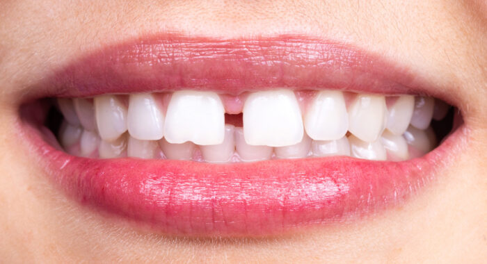 Frenulo corto: cos’è e come si interviene