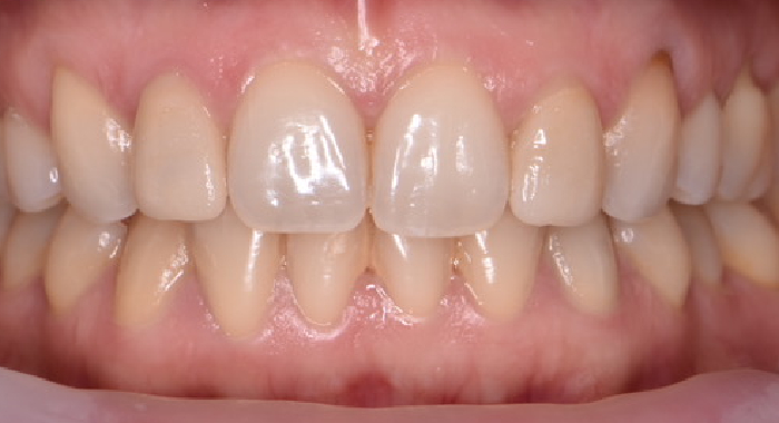 Faccette Dentali: la soluzione perfetta per un sorriso brillante