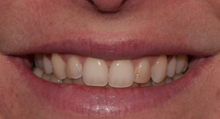 Prima dell'intervento delle faccette dentali